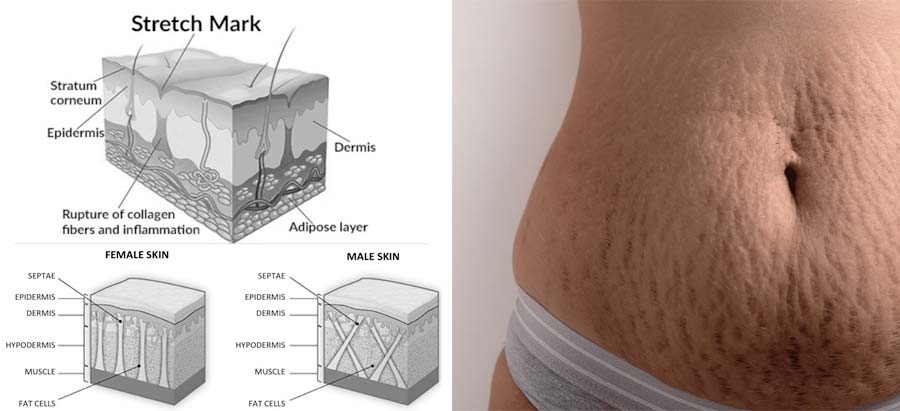 Herbal Cure for Stretch Marks