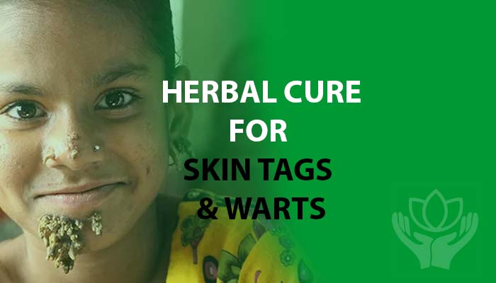 Natural cure for Warts and Skin Tags