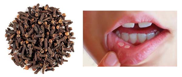 Herbal Cure for Mouth Ulcers